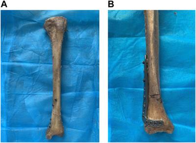 Comparative experimental study of the biomechanical properties of retrograde tibial nailing and distal tibia plate in distal tibia fracture